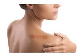 Skin Repair Study Based on 3Dmicroflu™